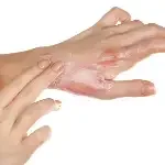 العناية بالجروح والحروق