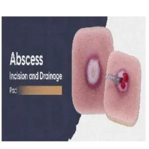 Abscess drainage and incision pad